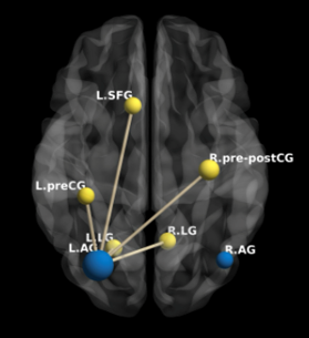 Structural covariance analyses demonstrated that brain regions within this AG-centered network showed a significant negative association with MSM-T, including bilateral postcentral gyrus and right precentral gyrus (sensorimotor cortex), left superior frontal gyrus (BA6), bilateral occipital lingual regions including the lingual gyrus and an extension to cerebellar dentate nucleus (FWE-corrected p<0.05)