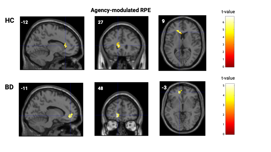 Significant Clusters in Frontal Brain for Agency-Modulated RPE in BD and HC